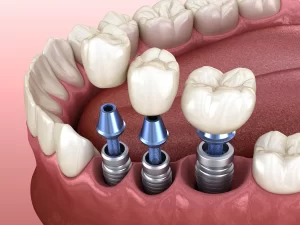 Implanty dentystyczne Warszawa