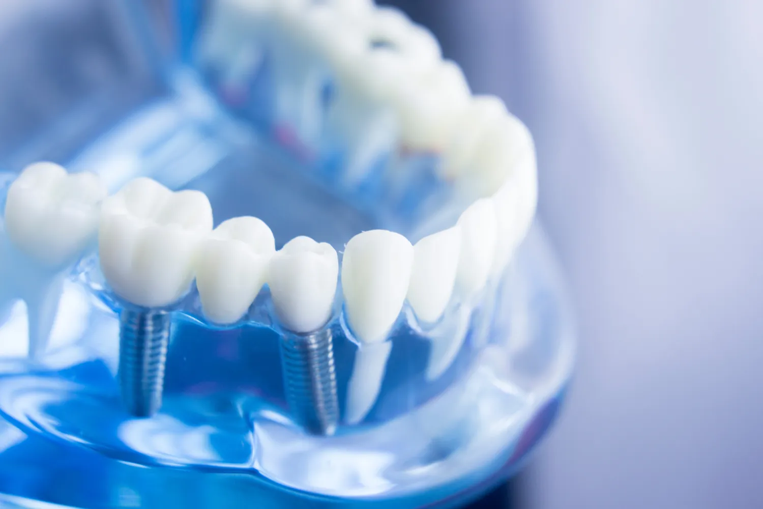 Ranking implantów zębowych - najważniejsze informacje