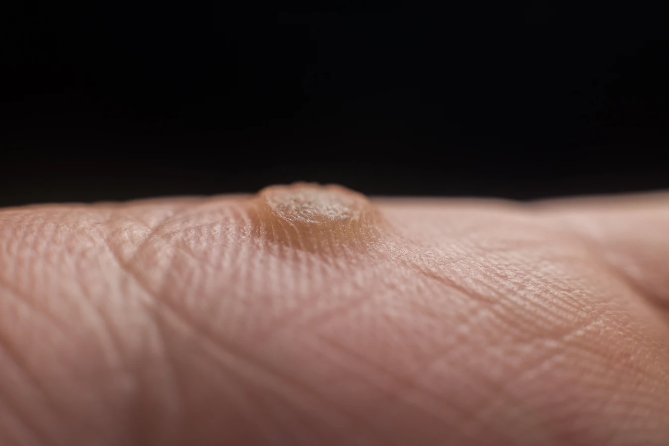 Co na kurzajki bez recepty?